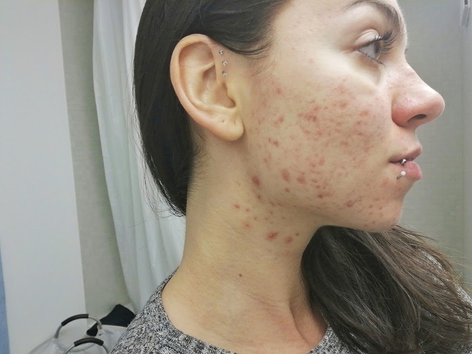 hormonal acne