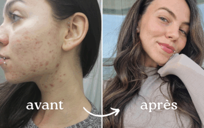Acné hormonale : Comment je l&rsquo;ai traitée 100% naturellement